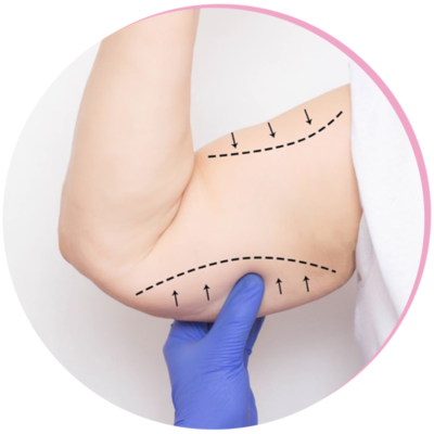 Brachioplasty