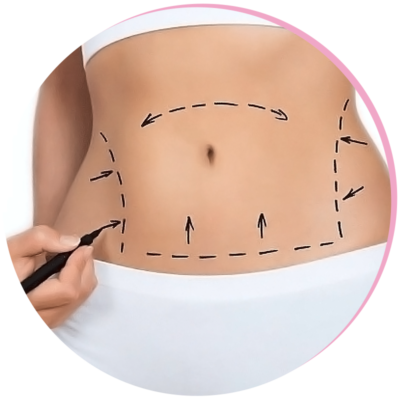 Tummy Tuck