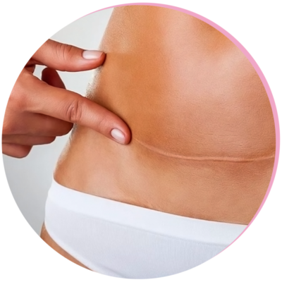 Scar Treatment