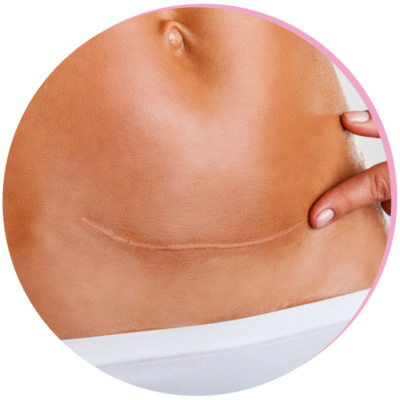 Scar Removal
