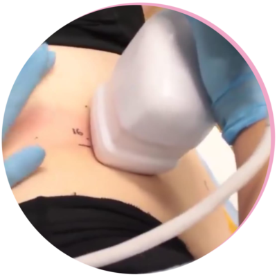 Lipohifu fat reduction