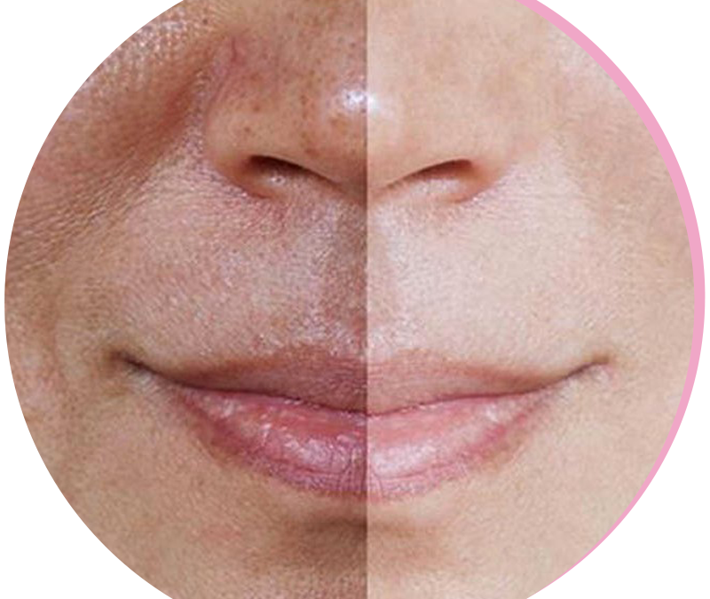Treatment of pigment spots