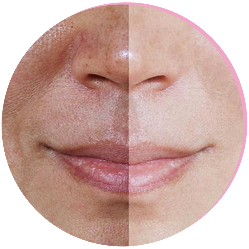 Pigmentfoltok kezelése