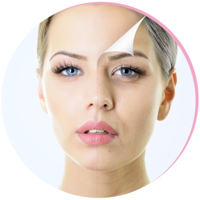 Chemical Peel