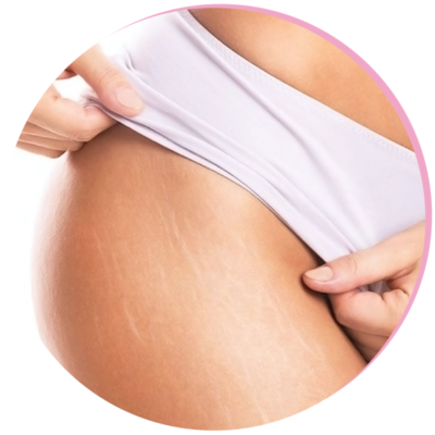 Stretch Mark Removal