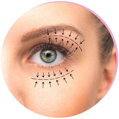 Blepharoplasty